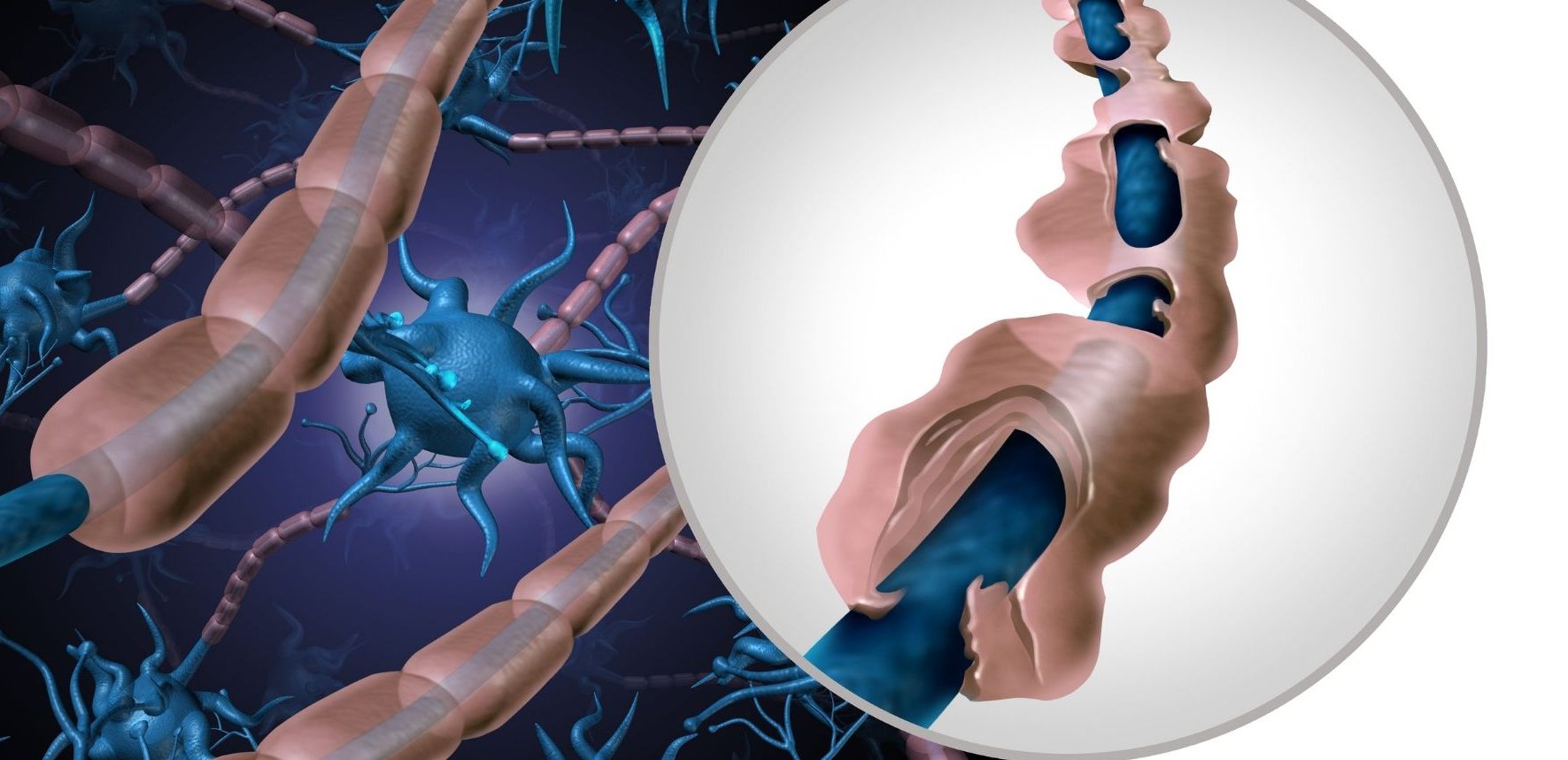 Global Multiple Sclerosis Drugs Market Overview And Prospects