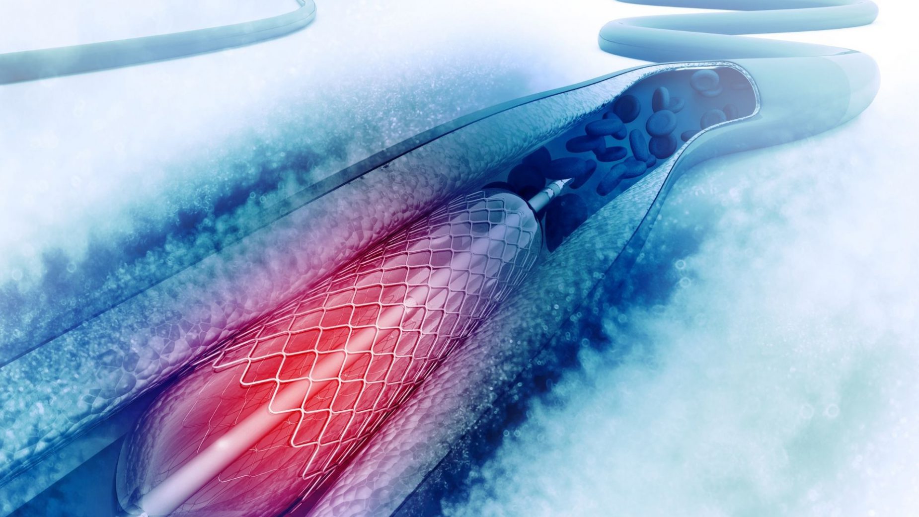 Global Bioabsorbable Stents Market Size, Forecasts, And Opportunities