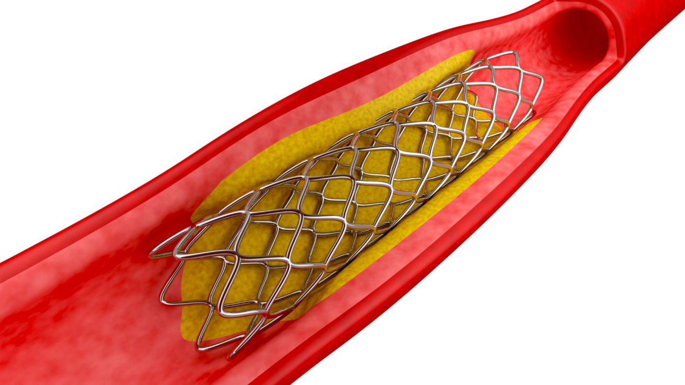 Global Coronary Atherectomy Devices Market Outlook, Opportunities And Strategies – Includes Coronary Atherectomy Devices Market Trends