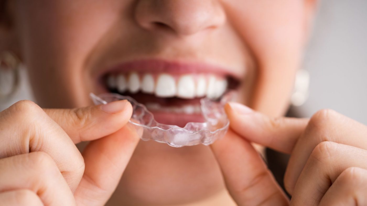 Take Up Global Clear Aligners Market Opportunities With Clear Industry Data – Includes Clear Aligners Growth