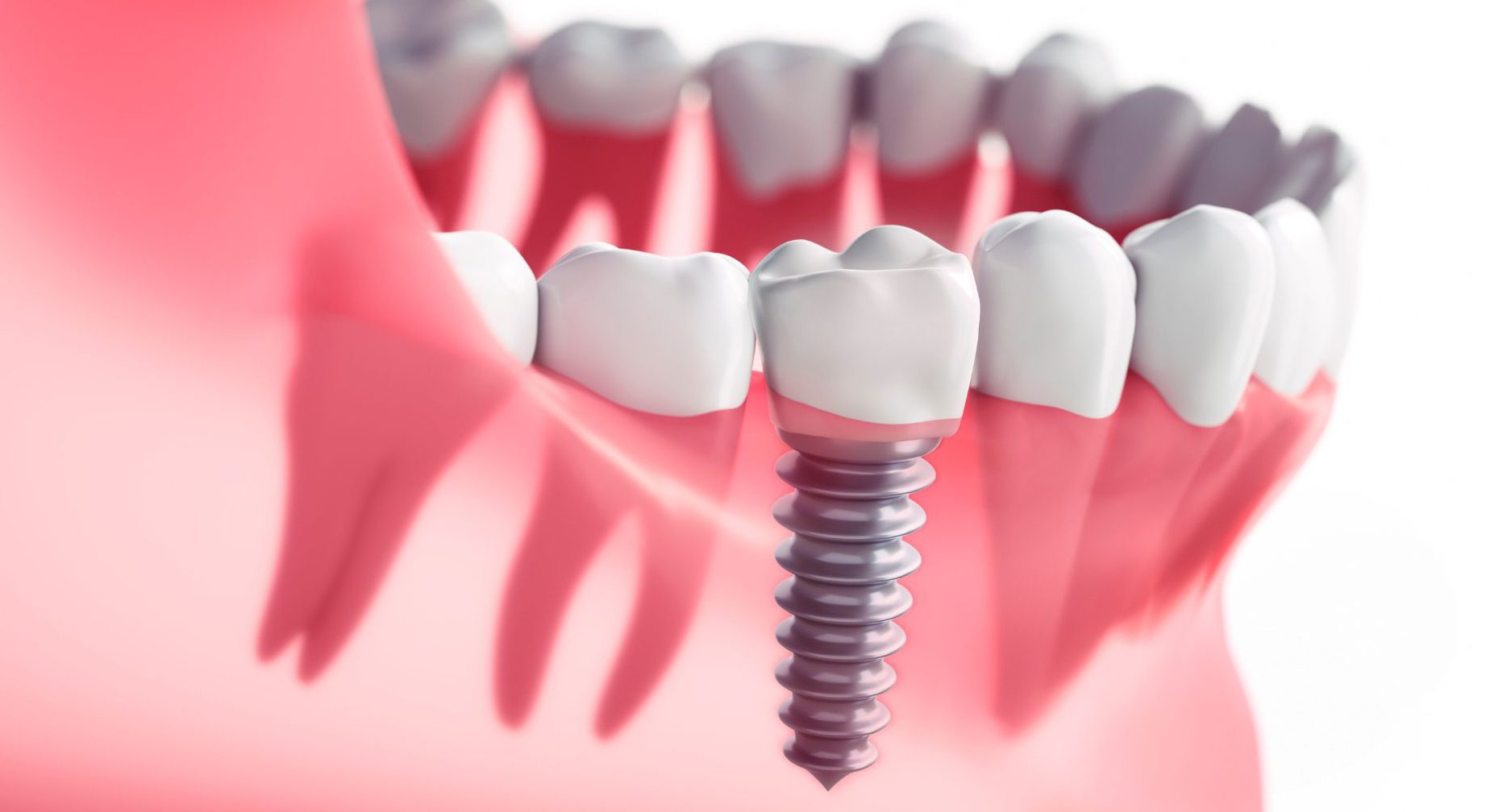 Global Dental Implants Market Overview And Prospects – Includes Dental Implants Market Share