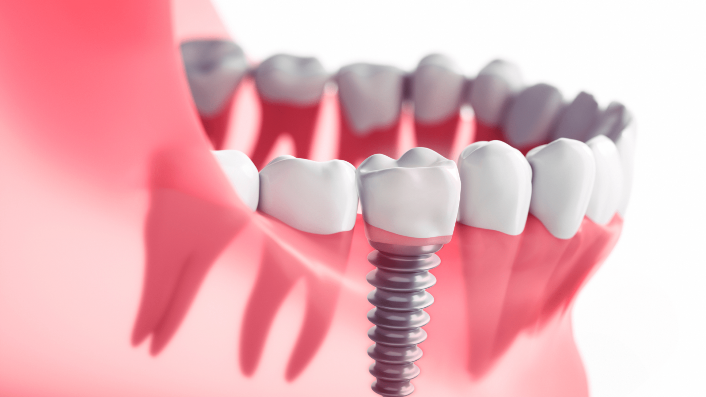 Dental Implants Market Growth Analysis And Indications – Includes Dental Implants Market Size