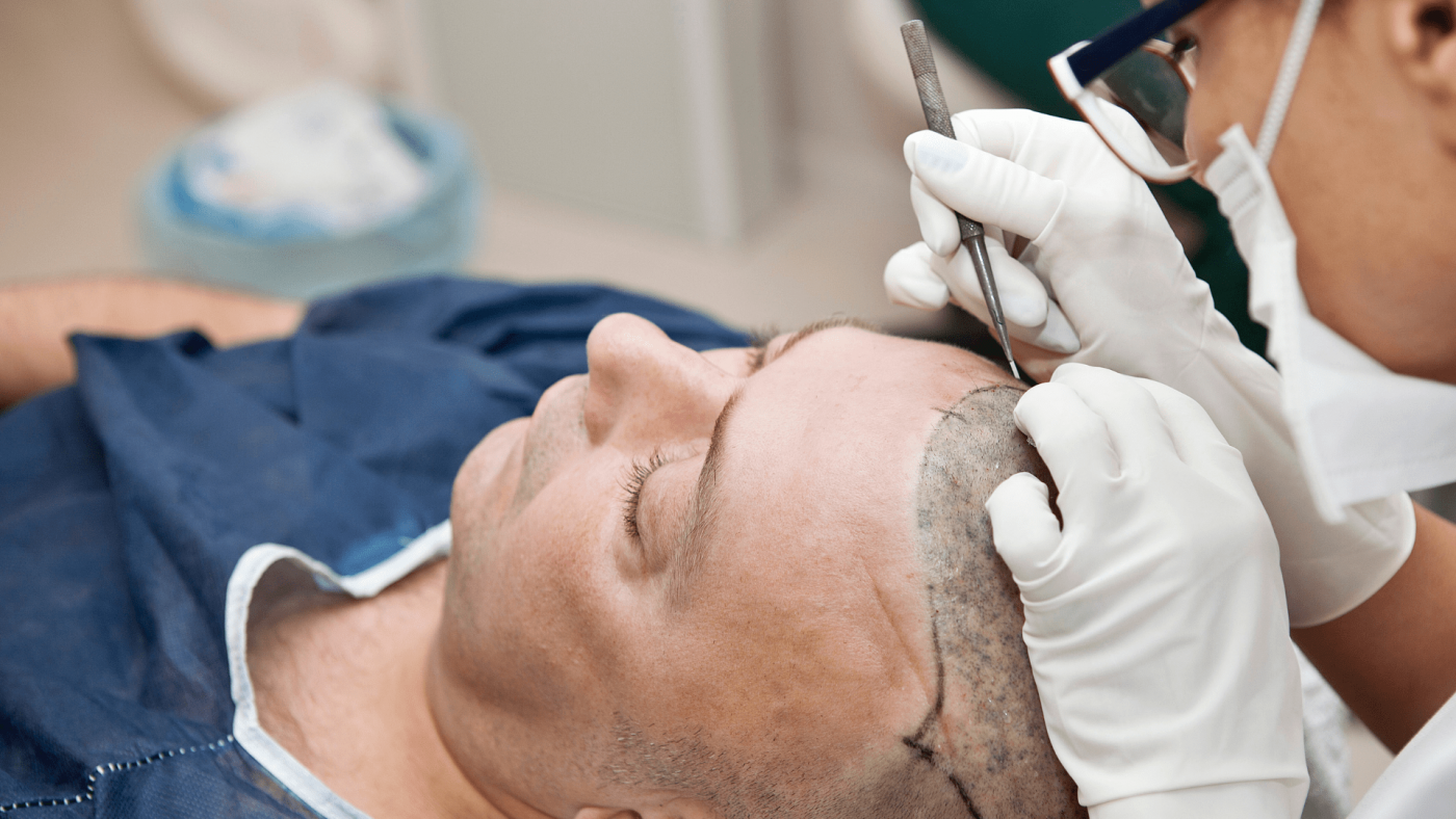 Insights Into The Hair Transplant Market’s Growth Opportunities Through 2023-2032 – Includes Hair Transplant Market Size